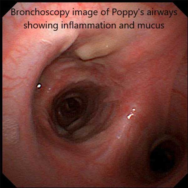 Eosinophilic Bronchopneumopathy
